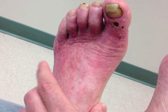 زخم های ایسکمیک