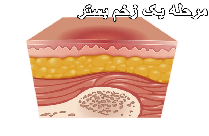 مرحله یک زخم بستر
