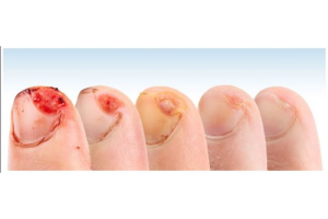 wound healing