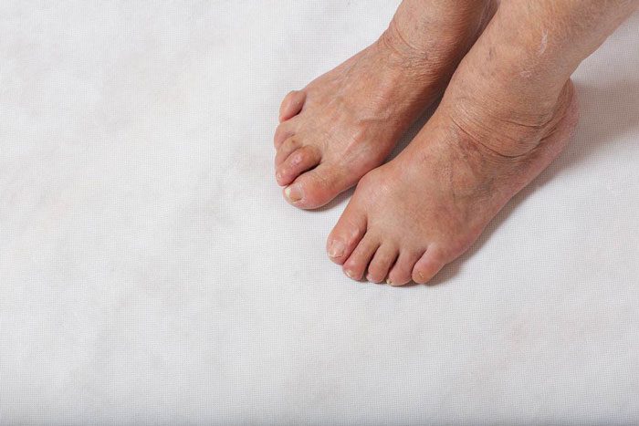 اگر دیابت دارید از پاهای خود مراقبت کنید