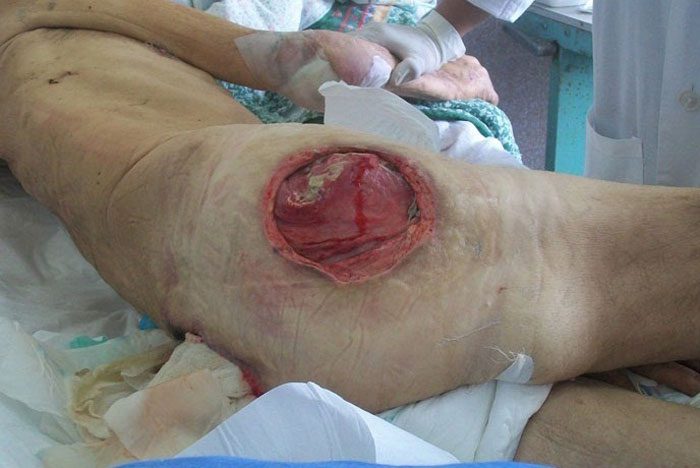 گزینه های درمان جراحی در زخم بستر کدامند؟