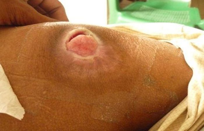 گزینه های درمان جراحی در زخم بستر کدامند؟