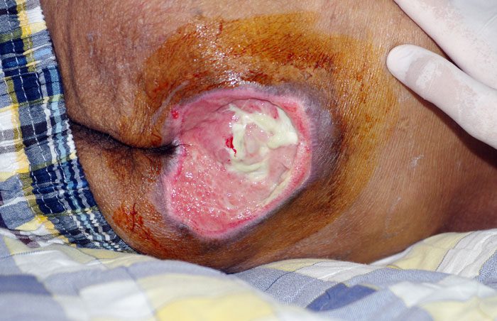 گزینه های درمان جراحی در زخم بستر کدامند؟