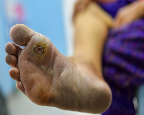 عفونت پای دیابتی 1