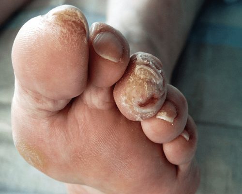 عفونت پای دیابتی