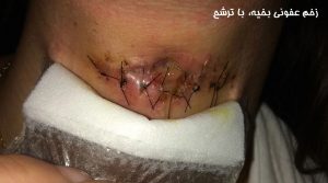 زخم عفونی بخیه با ترشح