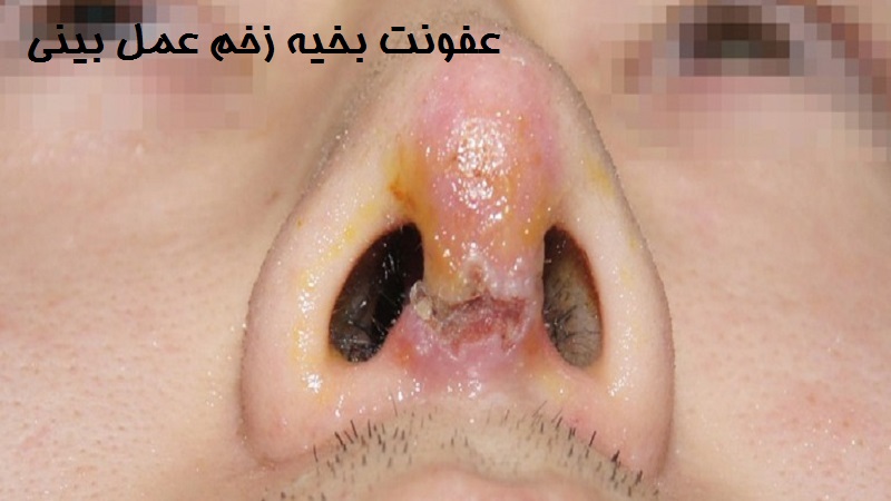 عفونت بخیه عمل بینی