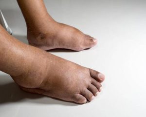 دیابت باعث سه آسیب اصلی و مشکلات جدی در پاها می شود