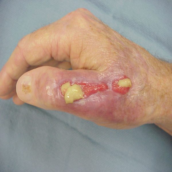 شناخت و بررسی انواع زخم عفونی 1