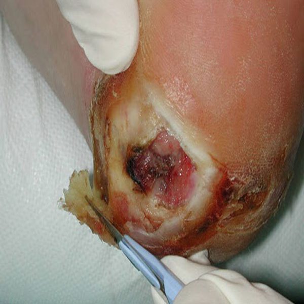 نکات مهم درباره درمان زخم های عفونی 1