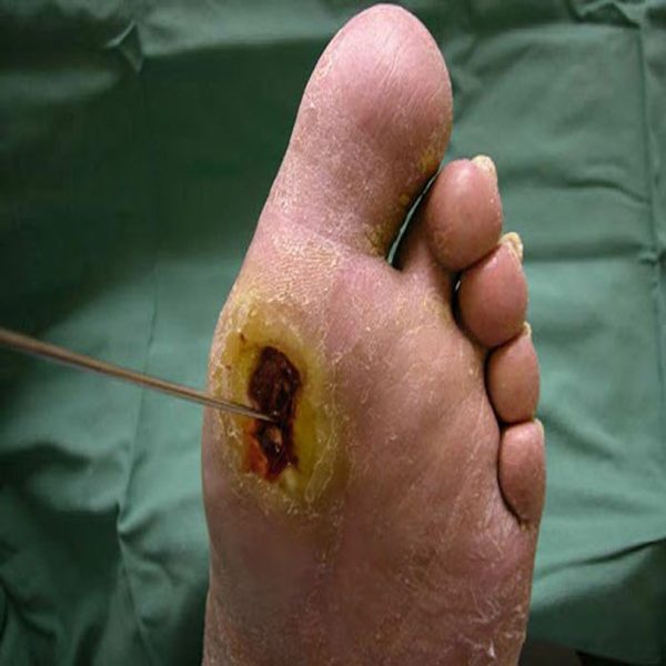 علل زخم های دیابتی و درمان آن ها 2