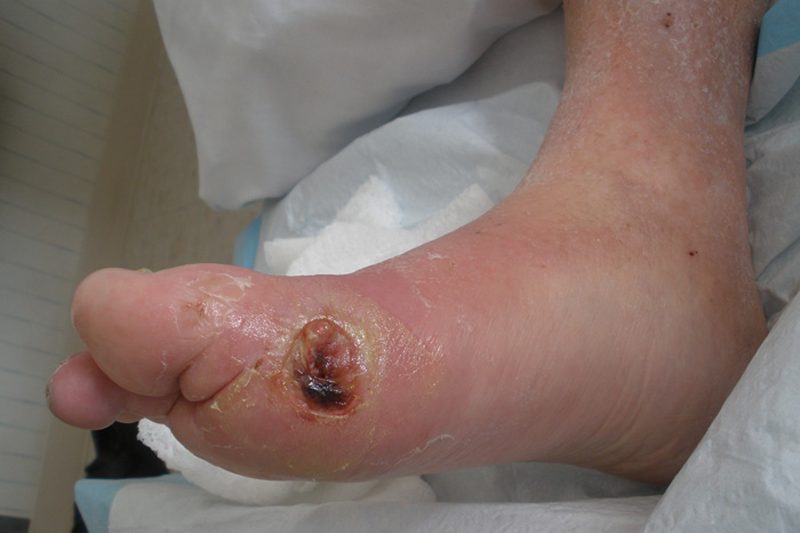 علل زخم های دیابتی و درمان آن ها