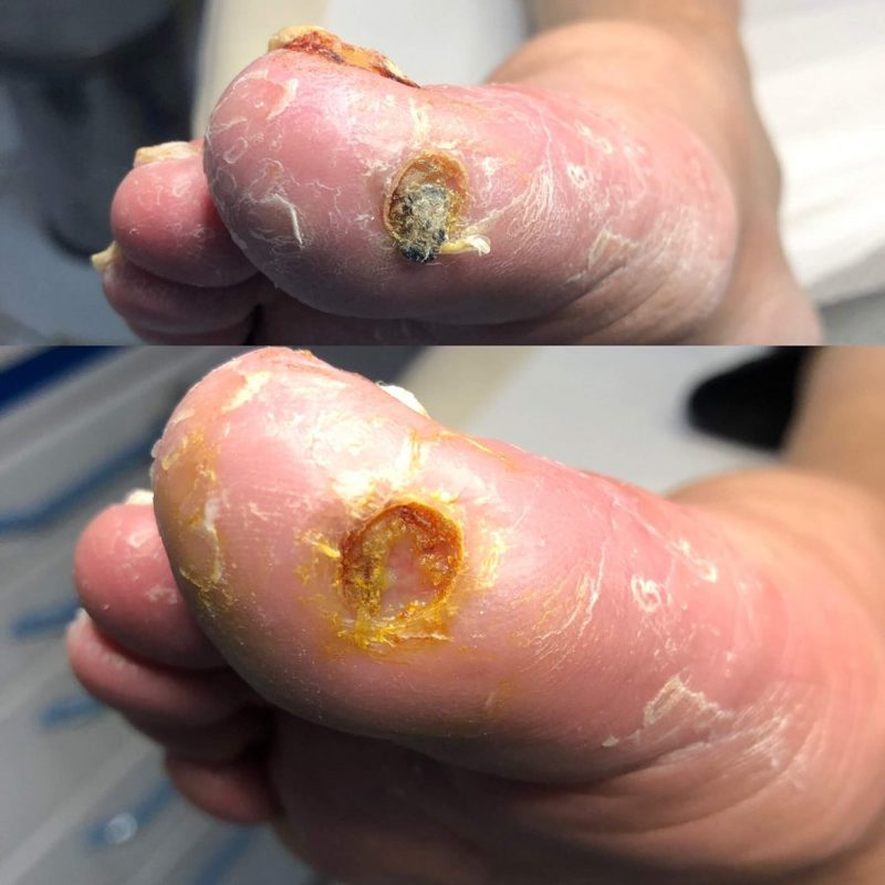 چه عواملی باعث ایجاد پای دیابتی می شود؟