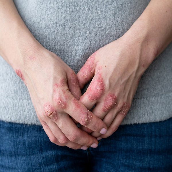 درمان سوختگی چگونه باید باشد؟ 1