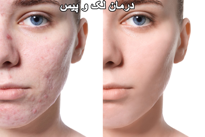 درمان لک و پیس