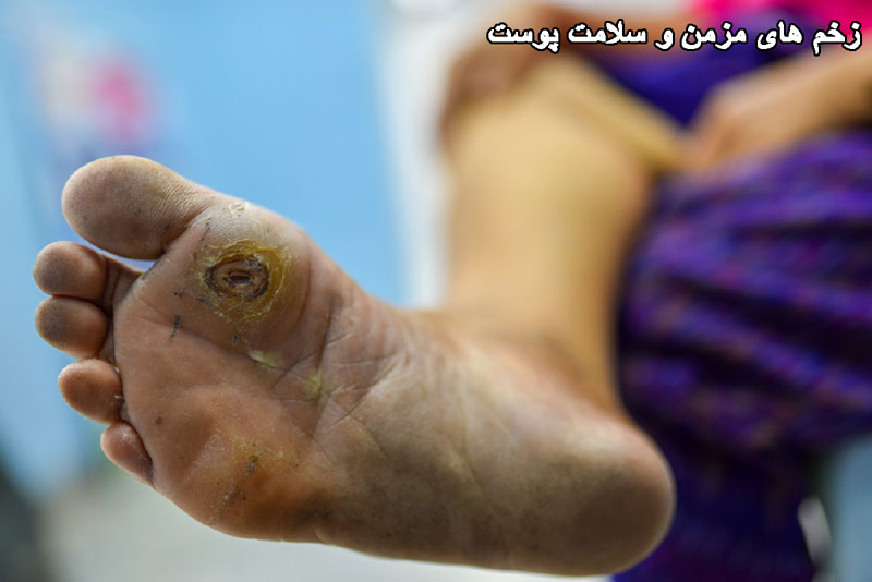 زخم های مزمن و سلامت پوست