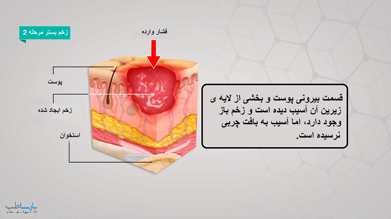 زخم فشاری درجه 2