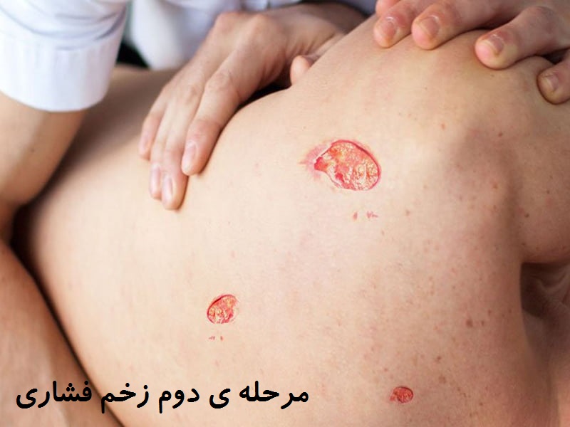 مرحله دوم زخم بستر