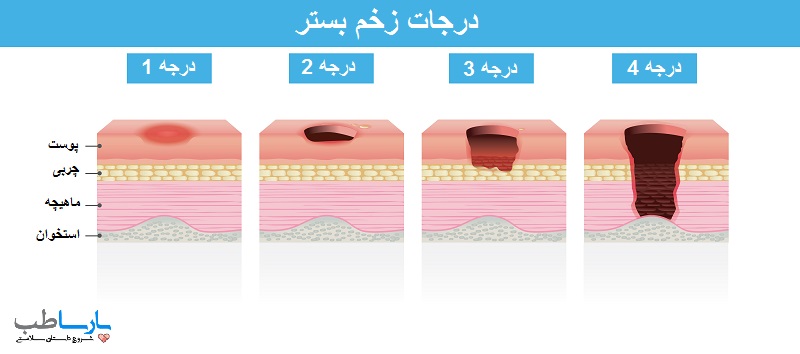 زخم فشاری درجه 2