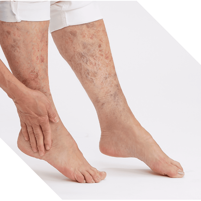 Legs with venous stasis disease mobile banner