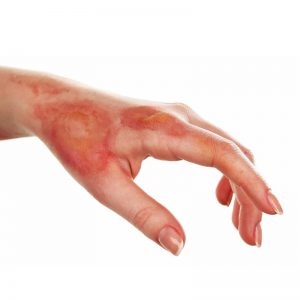 burn skin