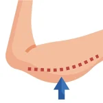 گن لیپوماتیک و لیفت بازو ( براکیوپلاستی )