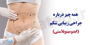 همه چیز در مورد عمل ابدومینوپلاستی