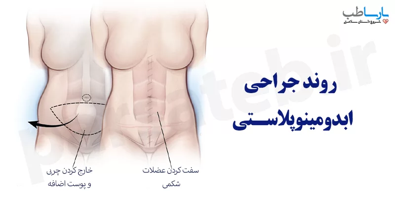 فرآیند عمل ابدومینوپلاستی