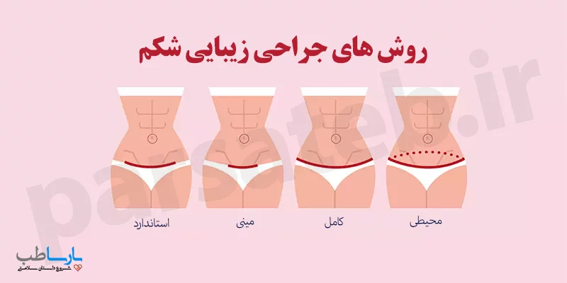 انواع روش های عمل ابدومینوپلاستی